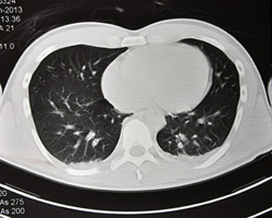 Chest computed tomography (CT) scan