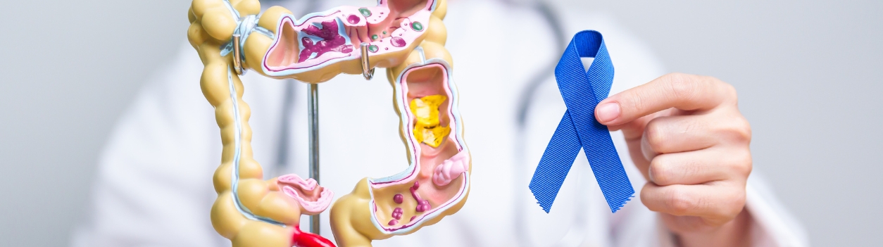SBM: early-onset-colorectal-cancer-finding-and-treating-polyps