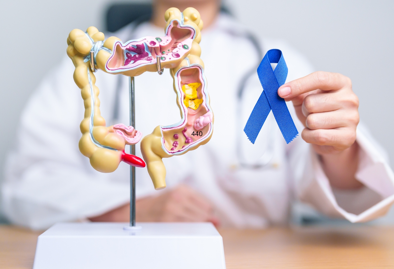 SBM: Early-Onset Colorectal Cancer: Finding and Treating Polyps